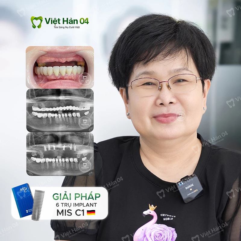 Trồng răng Implant toàn hàm hàm trên All On 6 - Implant Mis C1 (Đức)