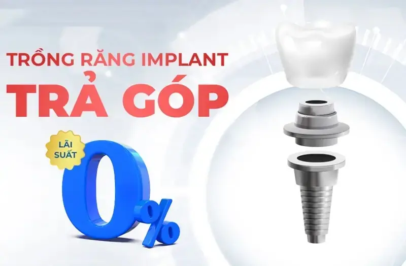 Chính sách trả góp Implant linh hoạt giảm áp lực tài chính 