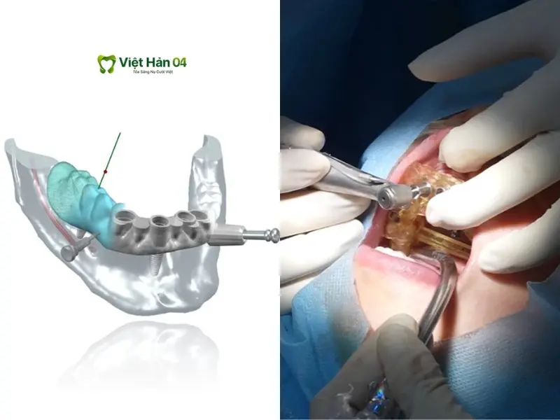 Đặt máng định vị 3D lên răng khách hàng và đưa trụ Implant vào vị trí qua lỗ định vị trên máng