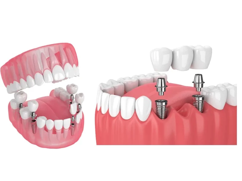Trồng răng Implant uy tín