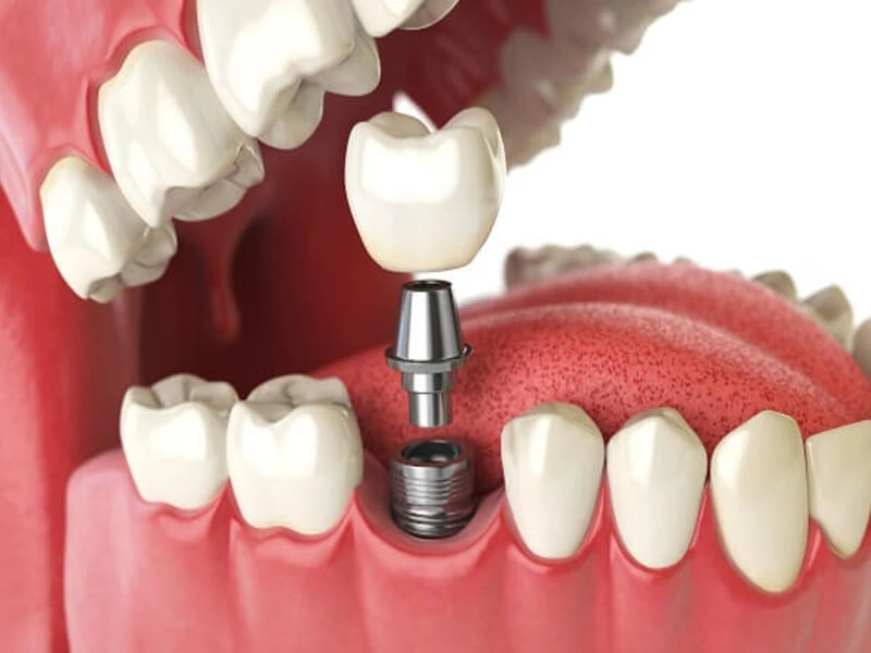 Trụ Implant titanium cấy trực tiếp vào xương hàm giúp ăn nhai khỏe và ngăn tiêu xương