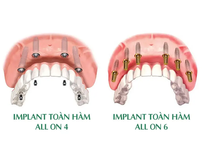 Implant toàn hàm All On 4 - 6