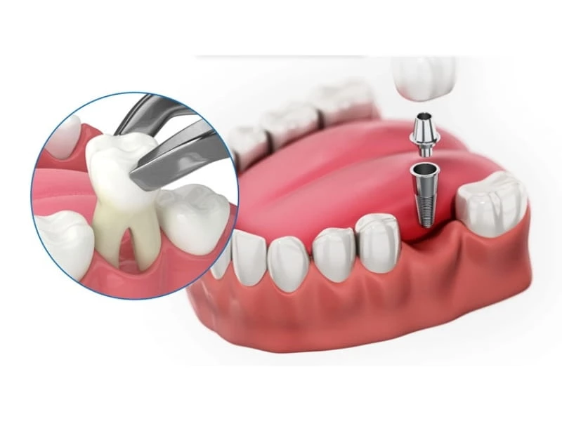 Trồng răng vĩnh viễn bằng phương pháp trồng răng Implant phục hồi toàn diện