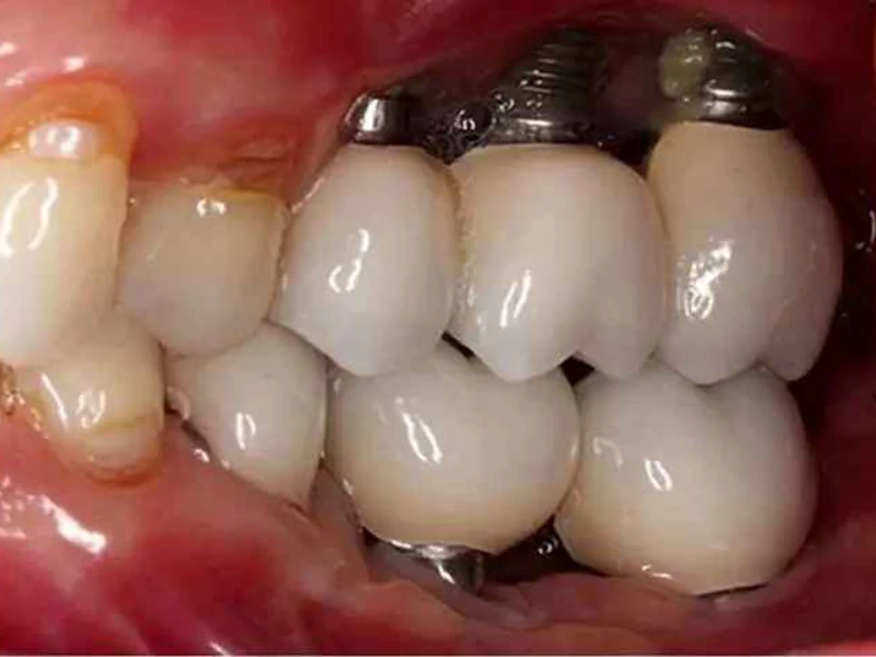 Trụ Implant bị lung lay: Trụ không tích hợp vào xương hàm mà có dấu hiệu lỏng lẻo.