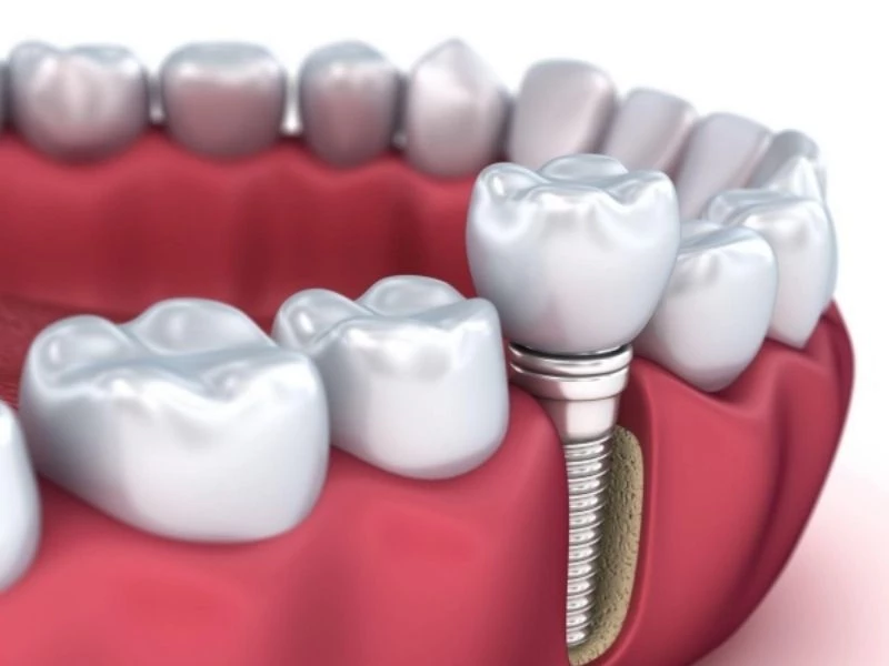 Trụ Implant chất lượng cao, hỗ trợ phục hồi thẩm mỹ và chức năng răng hiệu quả