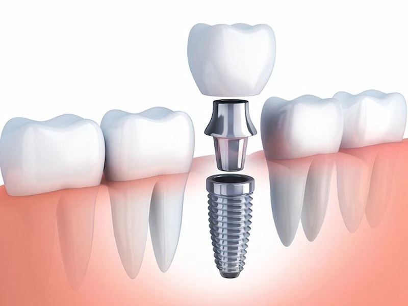 Trụ Implant chính hãng, giải pháp phục hồi răng bền vững với thời gian lâu dài 