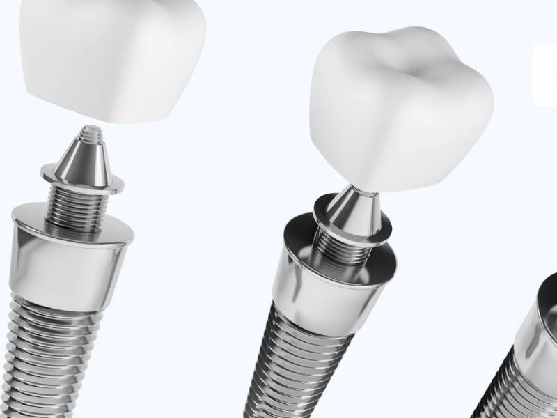 Trụ Implant hiện đại, lựa chọn tối ưu cho nụ cười chắc khỏe và tự tin. 