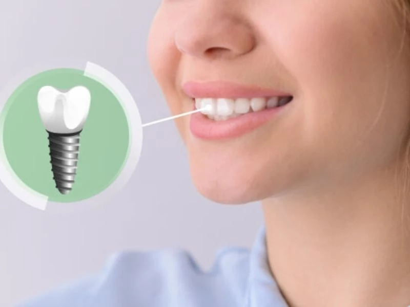 Tuổi thọ răng implant cao nhờ khả năng tích hợp xương hoàn hảo