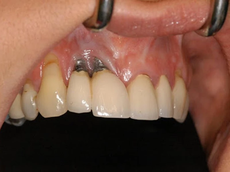 Hình ảnh lâm sàng implant bị đào thải và lộ trụ do viêm quanh implant