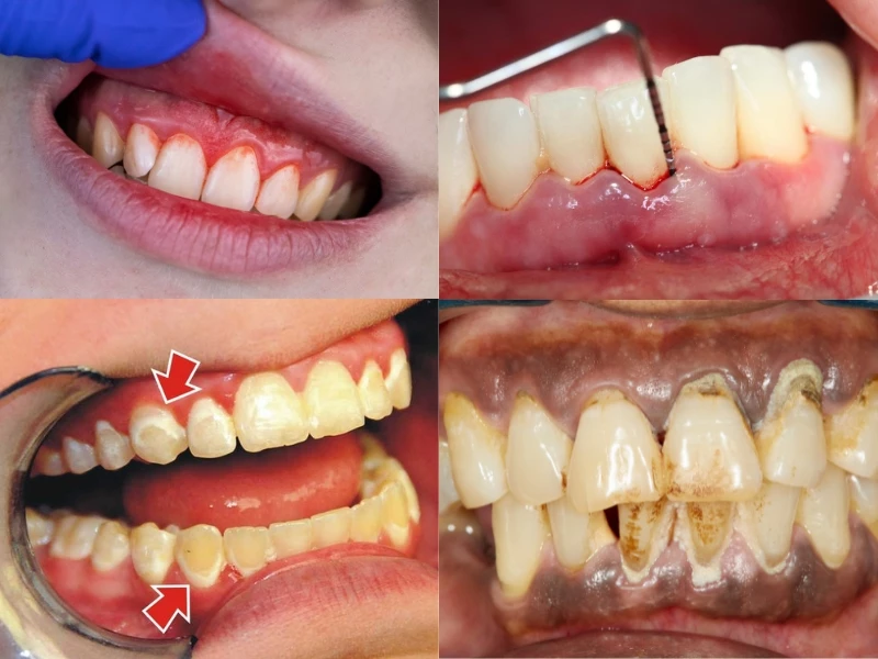 Mô tả viêm lợi, mòn men răng và viêm nha chu