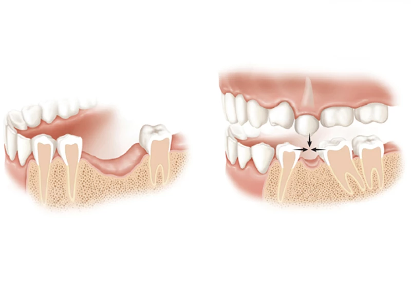 Mật độ xương không đủ khi cấy ghép implant