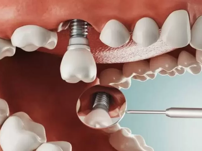 Trụ implant bị lộ thân và lỏng lẻo do viêm quanh implant