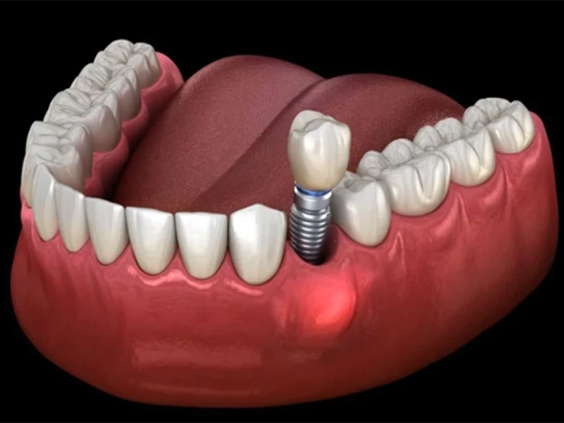 Sưng đau, viêm nhiễm ngay điểm cắm implant