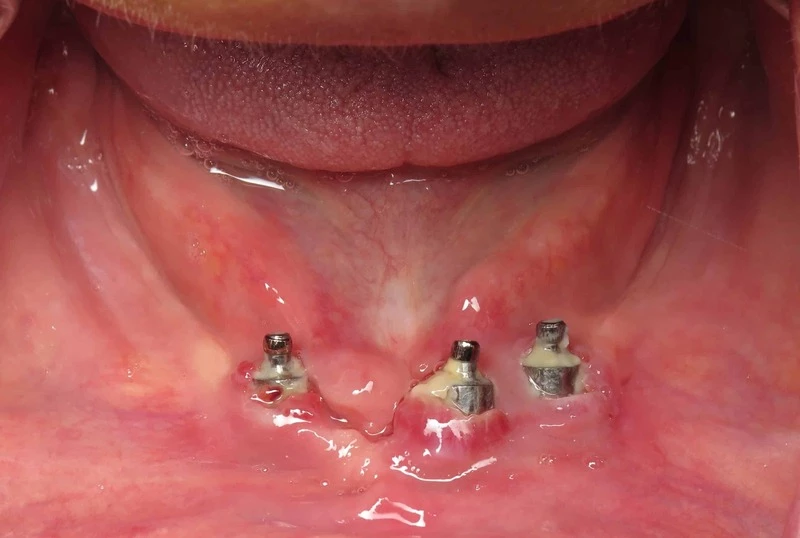 Viêm lợi, tụt lợi quanh trụ implant