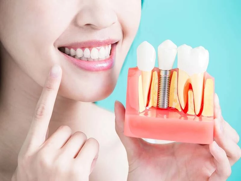 Trồng răng Implant giúp khôi phục ăn nhai, ngăn tiêu xương và bảo tồn răng thật