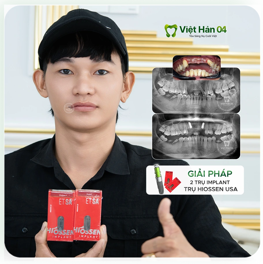 Giải pháp: Cắm 2 trụ Implant Hiossen USA