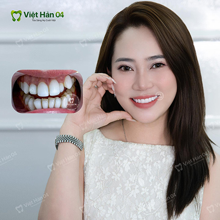 Nhan sắc thăng hạng sau khi làm 20 răng sứ Lava Plus