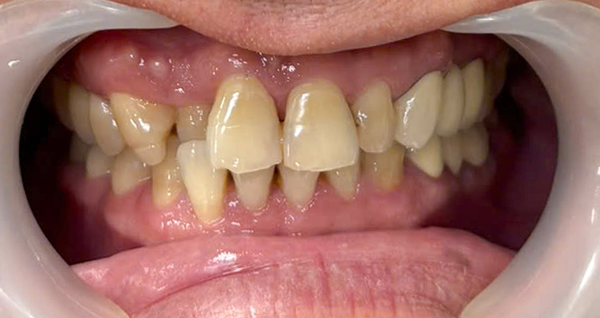 Răng lệch lạc, <br>thưa kẻ